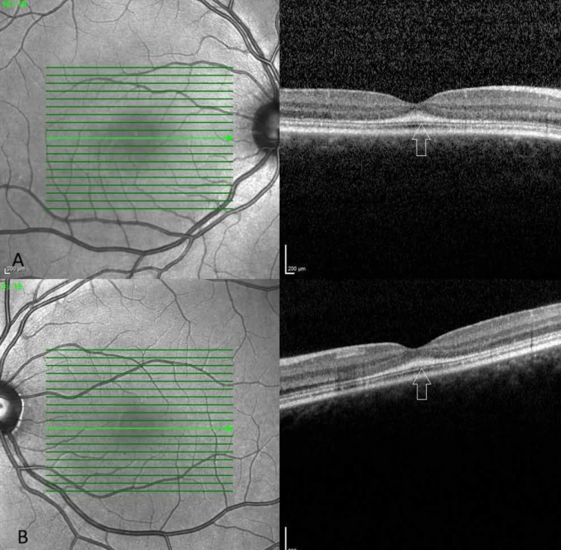 Optická koherenční tomografie se spektrální doménou (SD-OCT) odhalila hyperreflektivitu ve vnější jaderné vrstvě (bílá šipka) v pravém (A) a levém (B) oku
