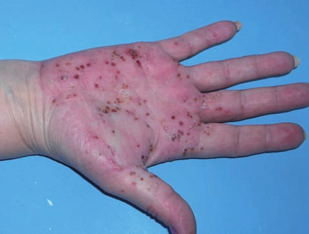 Psoriaziformná kožná erupcia u pacienta s morbus Crohn počas liečby adalimumabom imitujúca palmoplantárnu pustulóznu psoriázu