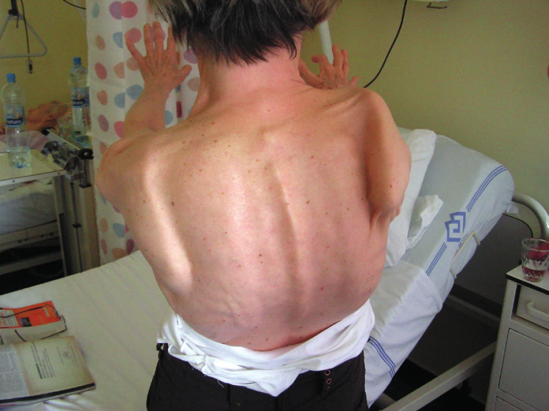 Oboustranná scapula alata (výraznější vpravo) u pacientky s facio-skapulohumerální formou svalové dystrofie. Jsou patrné výrazné pletencové atrofie. Odstávající pravá lopatka je zároveň vyrotovaná dolním úhlem vzhůru následkem převahy ventrálních svalů. Kromě m. serratus ant. jsou v různé míře oslabené i další pletencové svaly. Vzhledem k parézám lopatkových svalů a nedostatečné fixaci lopatek, je elevace HK možná jen do horizontály. Nález pozvolna progredoval.