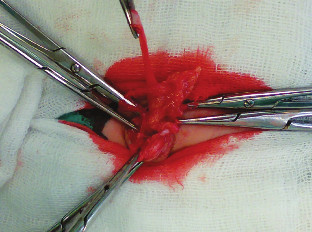 Resekce urachus persistens
Fig. 3. Resection of the urachus persistens