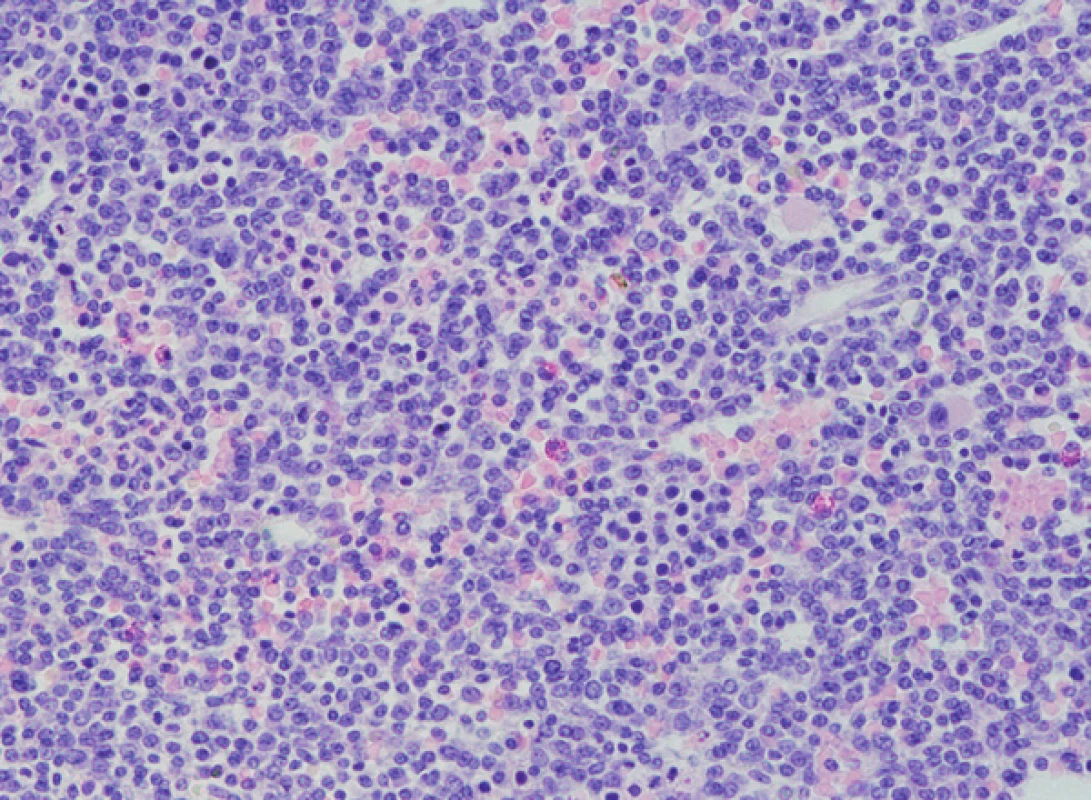 Histologické vyšetření kostní dřeně, nesekreční myelom, masivní infiltrace kostní dřeně, četné méně diferencované myelomové elementy až plazmablastického vzhledu (barvení HE, zvětšení 200x).