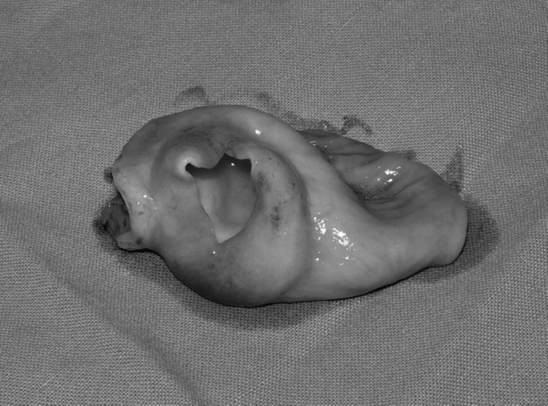 Otvorená črevná duplikatúra má hrubú stenu. Jej obsahom bola rôsolovitá číra tekutina,
ktorá po otvorení vytiekla.
Fig. 6. Open intestinal duplication has a thick wall. It contained a gel-like clear liquid, which
leaked out after opening of the duplication.