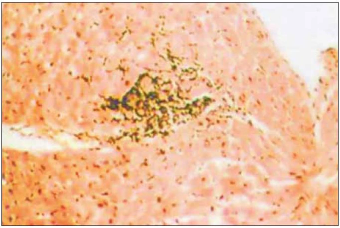 Histologický obraz akutní buněčné rejekce grade 2 podle Billinghamové et al.