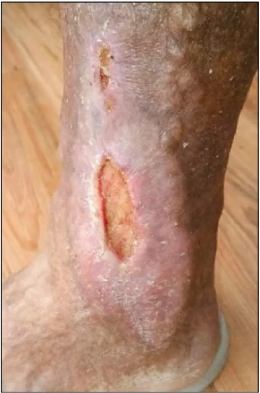 – Vřed velikosti 4 × 1,5 cm a dva menší defekty do 1 cm (dx.).