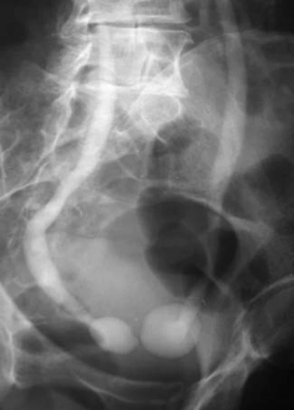 Ureterokéla (IVU).
