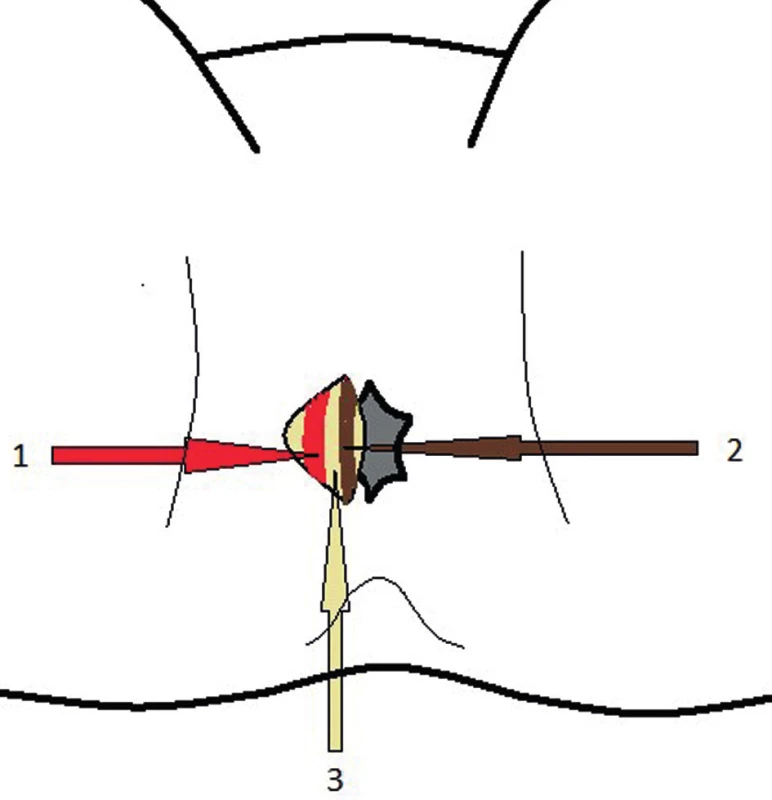 Přístup do intersfinkterického prostoru
1 – m. sphincter ani externus, 2 – m. sphincter ani internus, 3 – interfinkterický prostor
Fig. 4: Approach to the intersphincteric area
1 – m. sphincter ani externus, 2 – m. sphincter ani internus, 3 – intersphincteric area