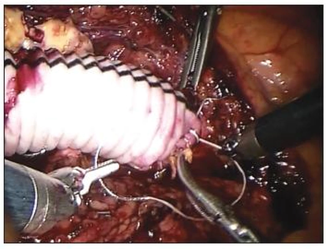 Centrální anastomóza výdutě břišní aorty
Fig. 8. Central anastomosis of the abdominal aortic aneurysm
