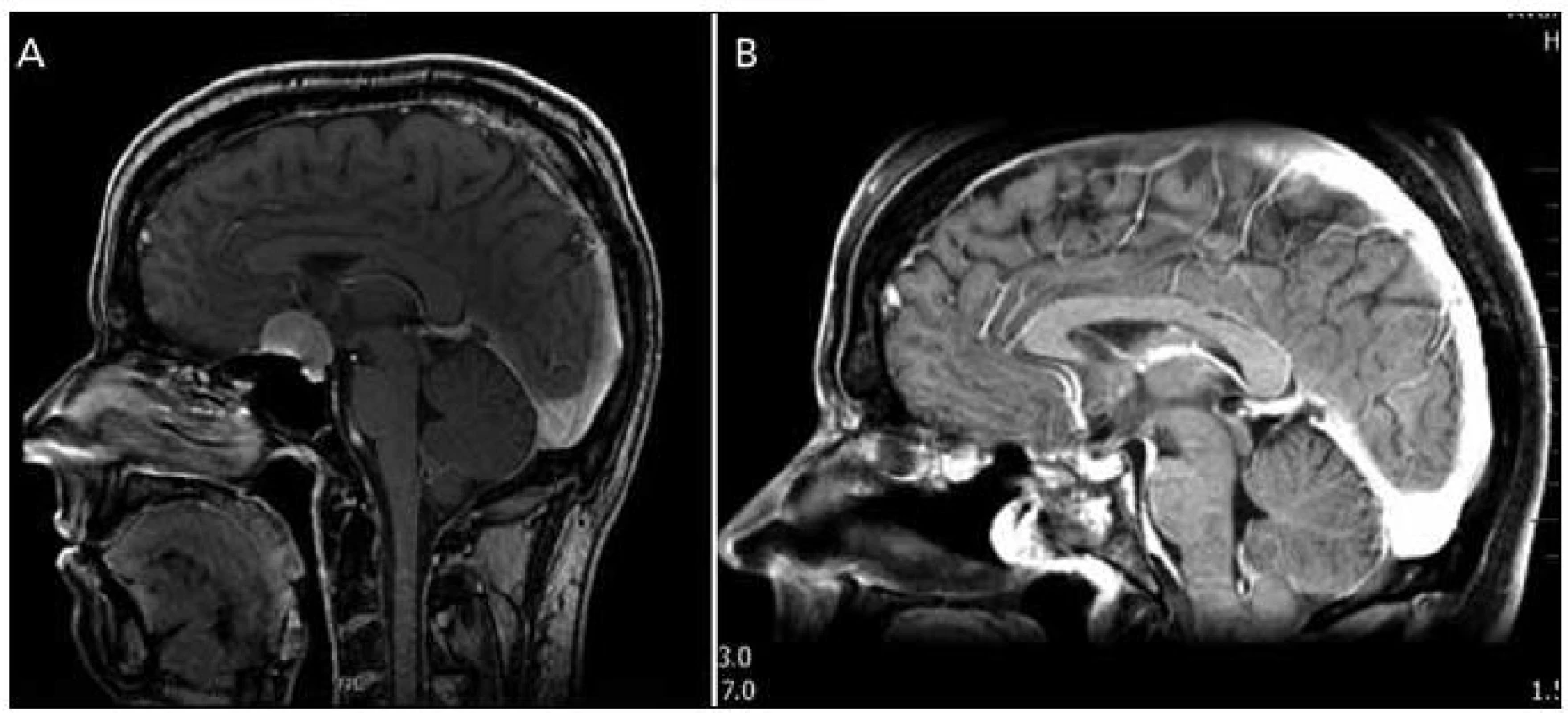 Meningeom planum sphenoidale a tubercullum sellae.
Obr. 5a) Předoperační MR.
Obr. 5b) Pooperační MR.