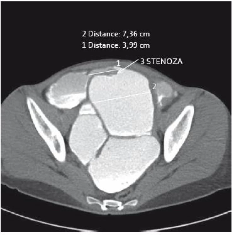 Ct-enteroklýza: těsná stenóza tenké kličky, edém střevní stěny, vymizení slizničního reliéfu a pre-stenotická dilatace střeva.
Fig. 4. Computed tomography enterography: tight stenosis of ileum with prestenotic dilatation, oedema of intestinal wall with reduction of mucosal relief.
