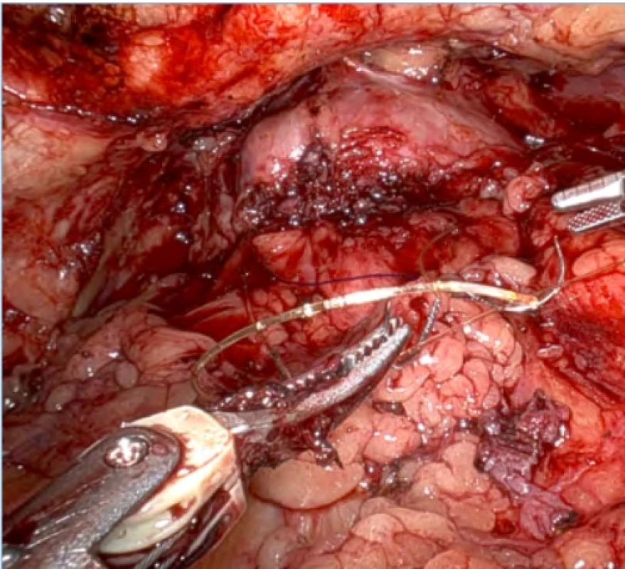Provedení sutury po odstranění adenomu prostaty. Fig. 4. Suturing after removal of prostate adenoma. 