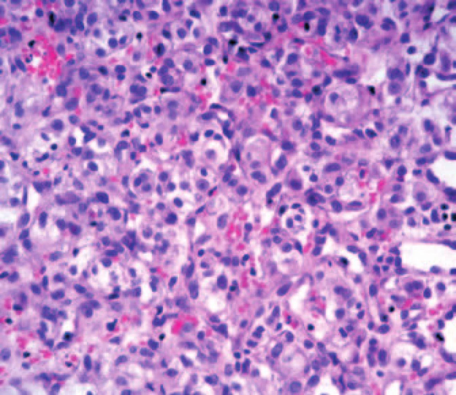 Biopsie – světlobuněčný renální karcinom.
Fig. 2. Biopsy – clear cell renal carcinoma.