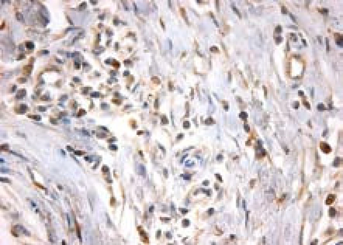 Početné imunohistochemicky verifikované IgG4 pozitivní plazmocity u autoimunní pankreatitidy.
Fig. 5. Numerous immunohistochemically verified IgG4 positive plasmocytes in autoimmune pancreatitis.