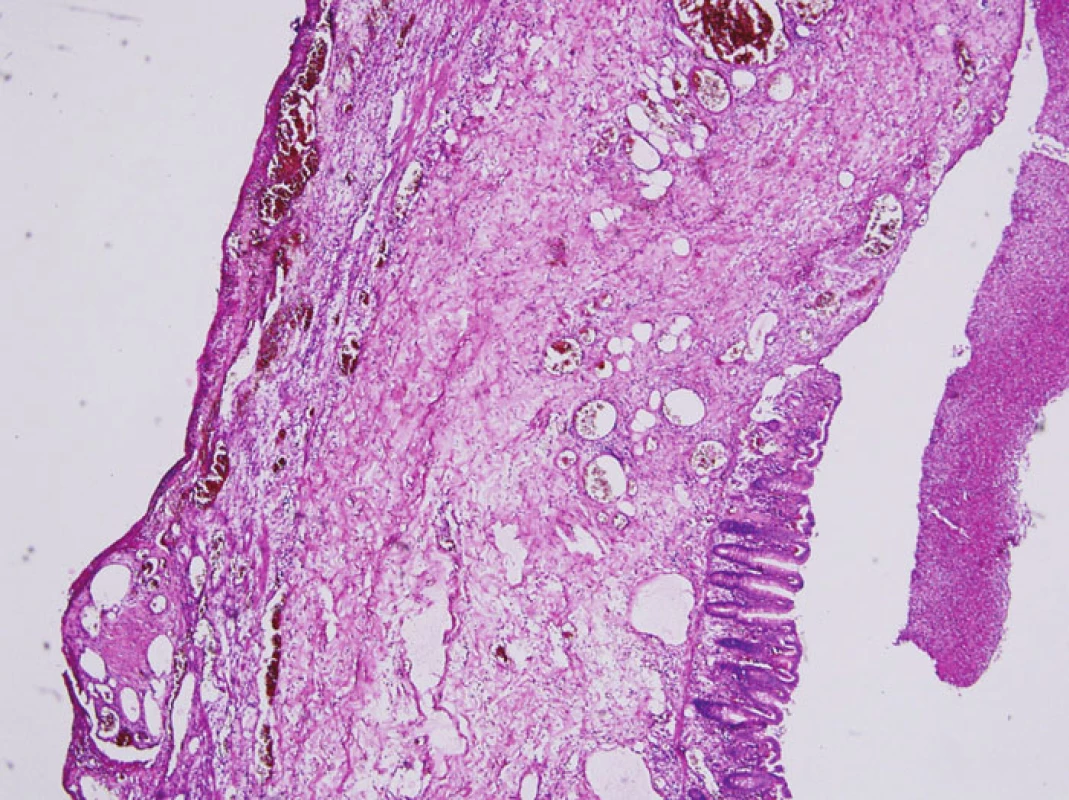 Stěna střeva s úplným chyběním muscularis propria, sliznice je zčásti zachovalá a zčásti nekrotická (barvení hematoxylin- eosin, zvětšeno 40x)
Fig. 1. Colonic wall with complete absence of the muscularis propria layer, the mucous membrane is partially preserved and partially necrotic (hematoxylin-eosin staining, 40x enlargement)