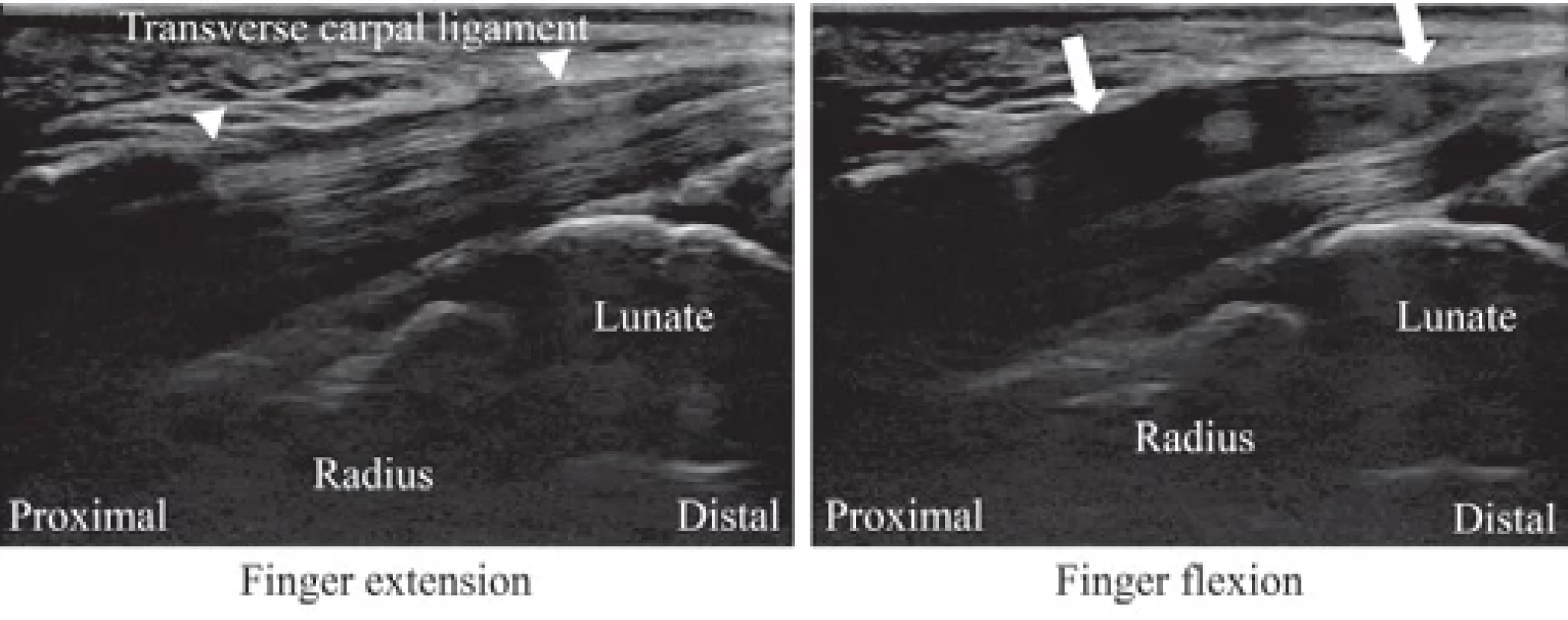 Preoperative ultrasonographic fi ndings (short axis image).