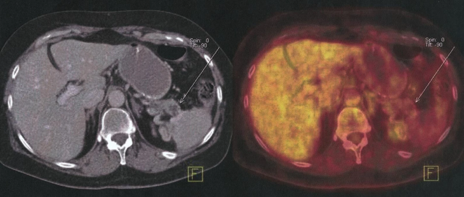 Správná a přesná lokalizace tumoru hlavy pankreatu T2, N0, M0
Fig. l. Correct and precise localization of pancreatic head tumour T2, N0, M0