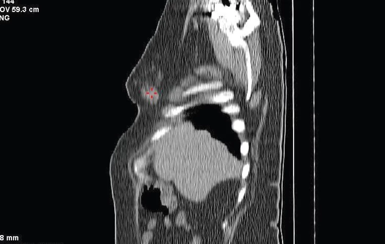 Low dose CT hrudníku – sagitální řez v měkkotkáňovém okně – v pravém prsu je patrné ložisko.