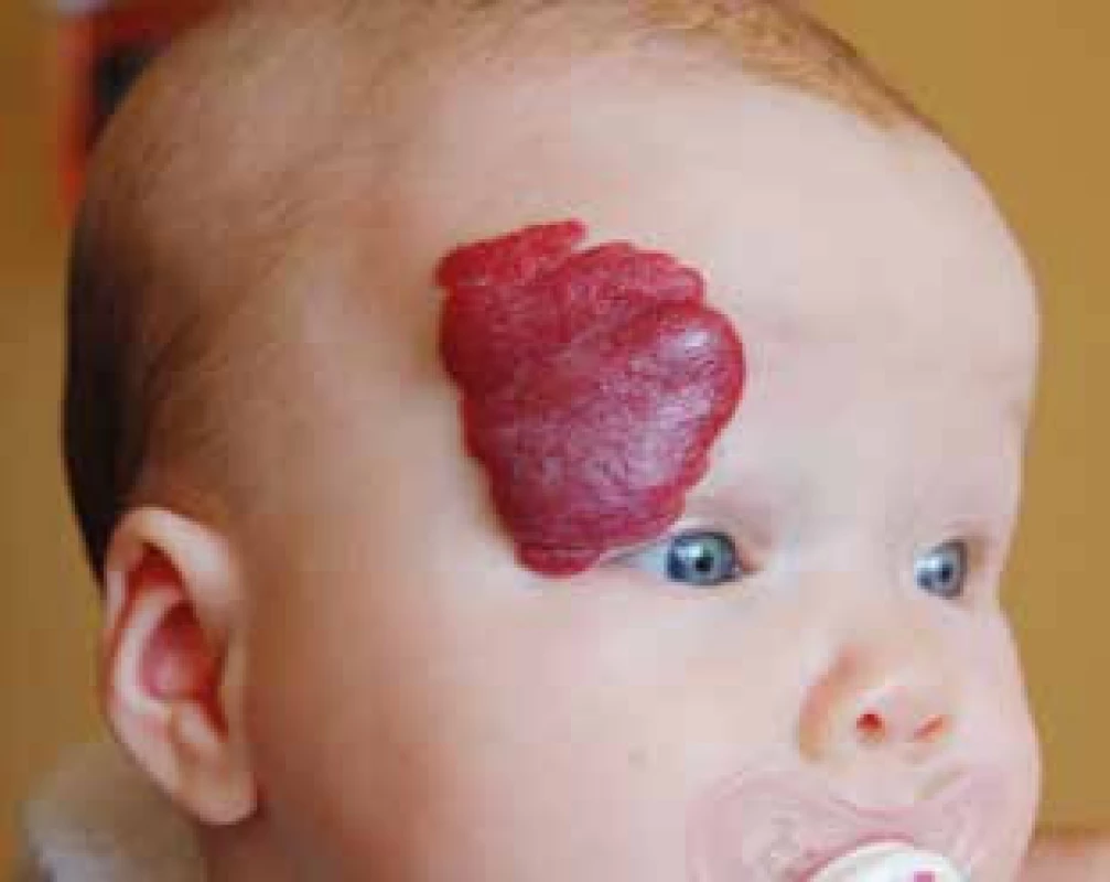 Infantilní hemangiom temporální a frontální oblasti s rizikem deformujícího rezidua.
Fig. 7. Infantile hemangioma of temporal and frontal area possibly evoluting towards disfiguring scar.