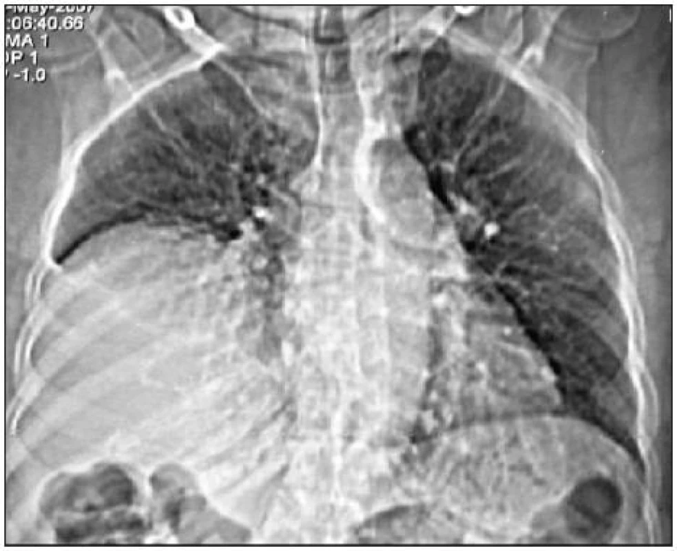 CT snímek hrudníku s hemidiaphragmatickou parézou vpravo (Kansal, 2009).
