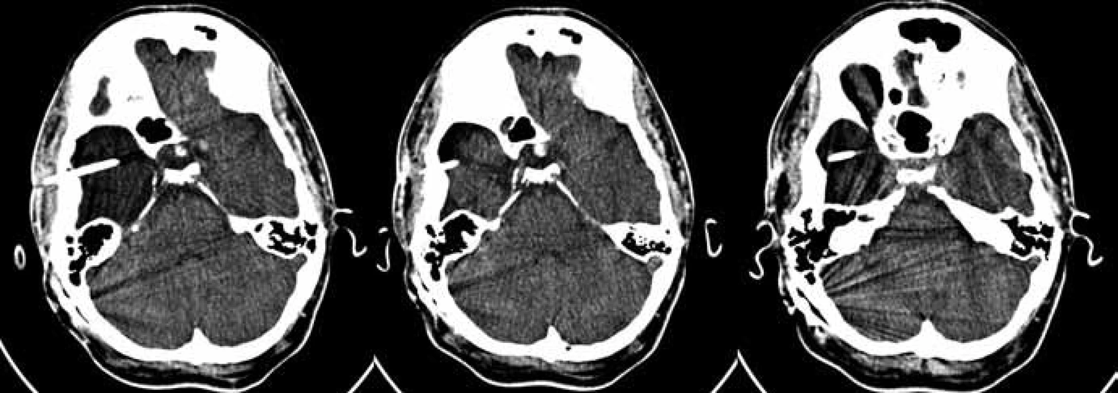 Na vyšetření pomocí výpočetní tomografie je vidět stav po implantaci cystoperitoneálního shuntu v pravé temporální oblasti. Na prostředním a pravém obrázku je vidět postupná regrese objemu arachnoidální cysty v průběhu času ve srovnání s obrázkem vlevo, který byl pořízen za týden po operaci.