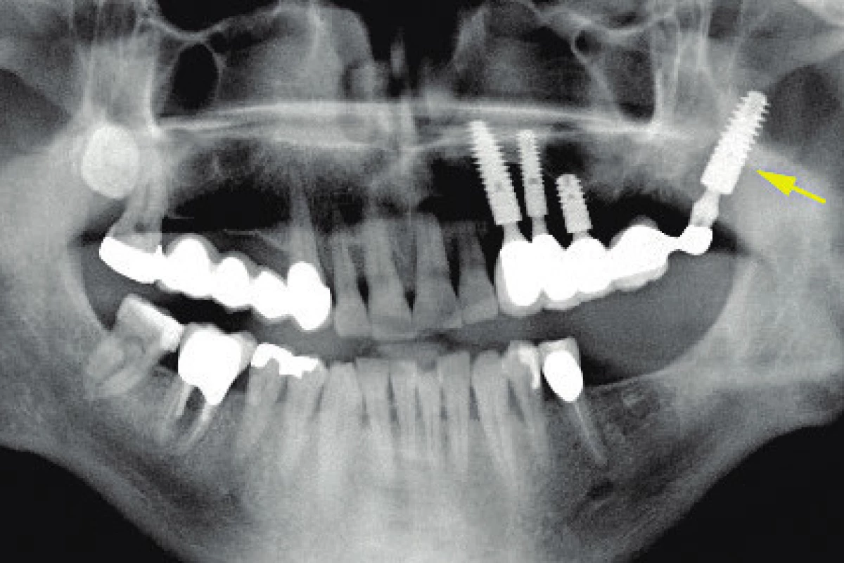 Pterygoidní implantát (šipka) zakotvený v kompaktě pterygoidních výběžků kosti klínové