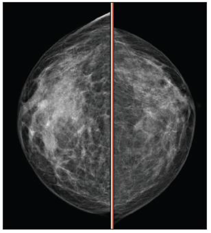 Mamografie pravého prsu
Fig. 10. Mamography of the right breast