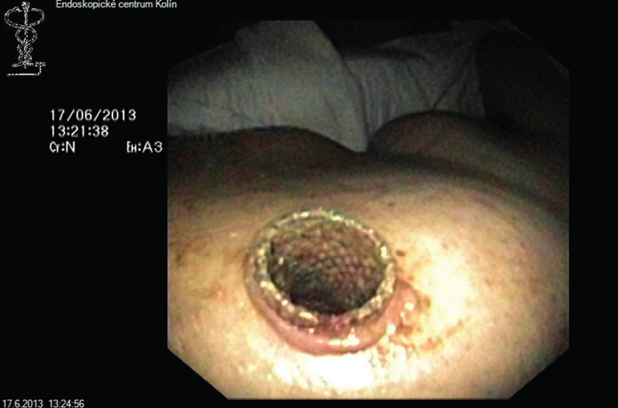 Perkutánně zavedený metalický stent
Fig. 2: Percutaneously implanted metallic stent