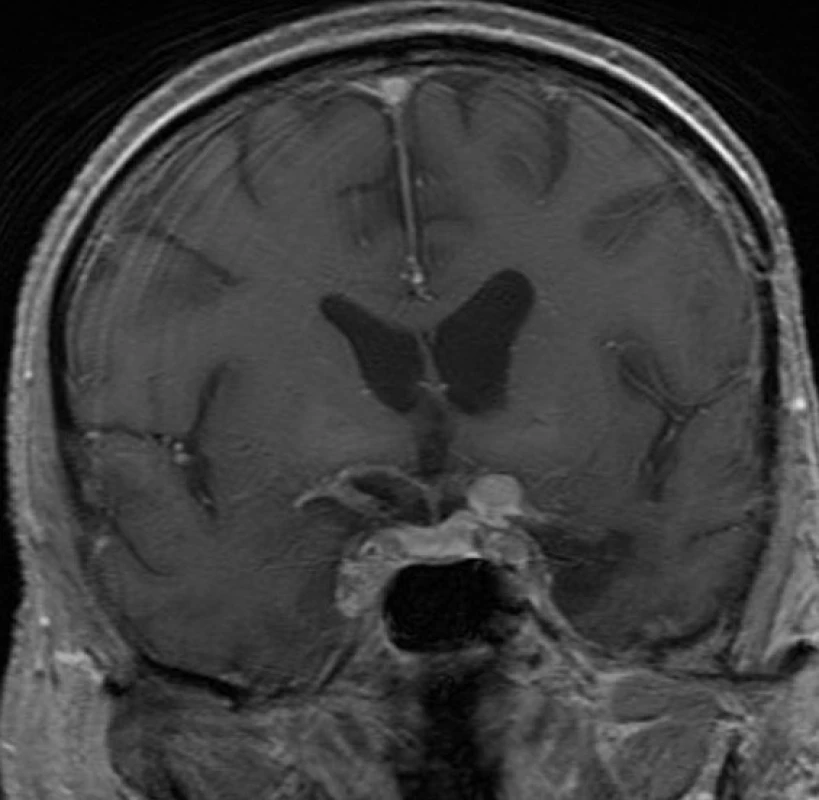 Kontrolní MRI 2 roky po výkonu prokazující progresi rezidua meningiomu (Na základě tohoto nálezu bylo indikováno ozáření na Leksellově gama noži)
Fig. 3: MRI 2 years after surgery showing the progression of residual tumor (Radiosurgery with the Leksell Gamma Knife was indicated based on this finding.)
