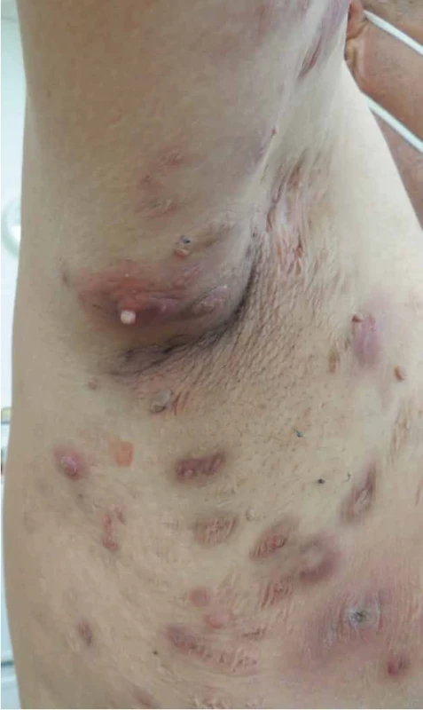 Hidradenitis suppurativa 