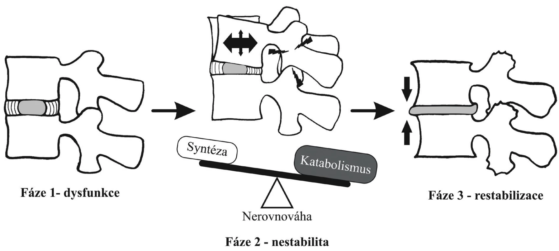 Fáze degenerativního procesu bederní páteře podle Kirkaldy-Willise a Farfana