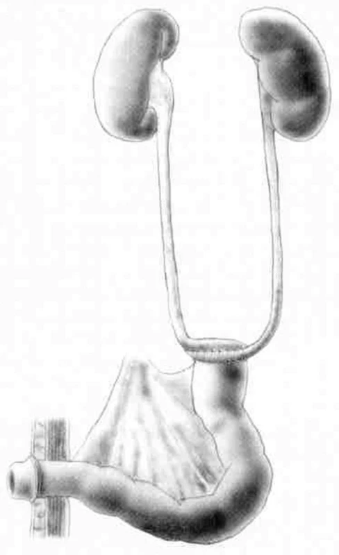 Ureteroileostomie podle Brickera s uretero-ileo anastomózou podle Wallace II.
převzato z: Dvořáček j, Babjuk M, et al. Onkourologie. Praha, Galén 2005:184.
Fig. 3: Ureteroileostomy according to Bricker with ureteroileal anastomosis according toWallace II
According to: Dvořáček J, Babjuk M, et al. Onkourologie. Praha, Galén 2005:184.