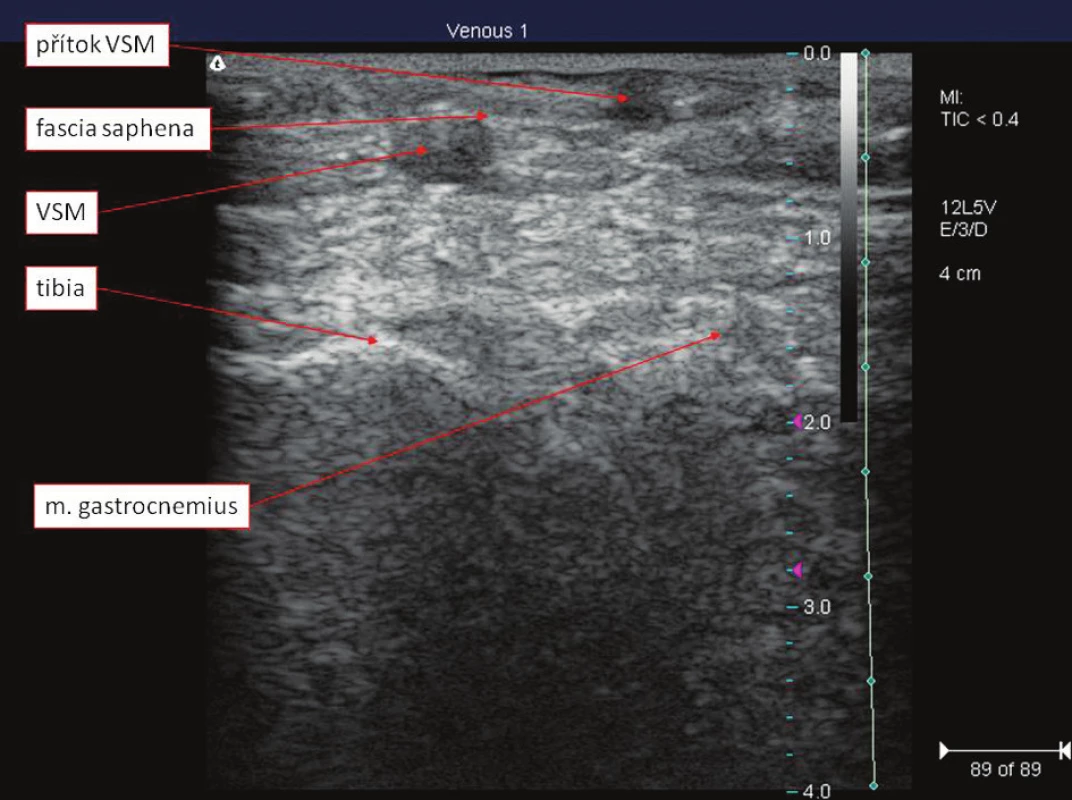 Topograficko-anatomické poměry VSM v oblasti kolene
Fig. 4. Topographic-anatomical relationships of VSM in the knee region