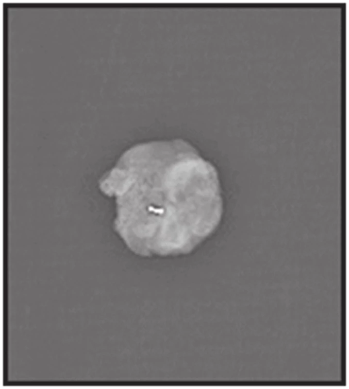 Sentinelová uzlina s klipem (rentgen)
Fig. 2: Sentinel node with the clip (X-ray)