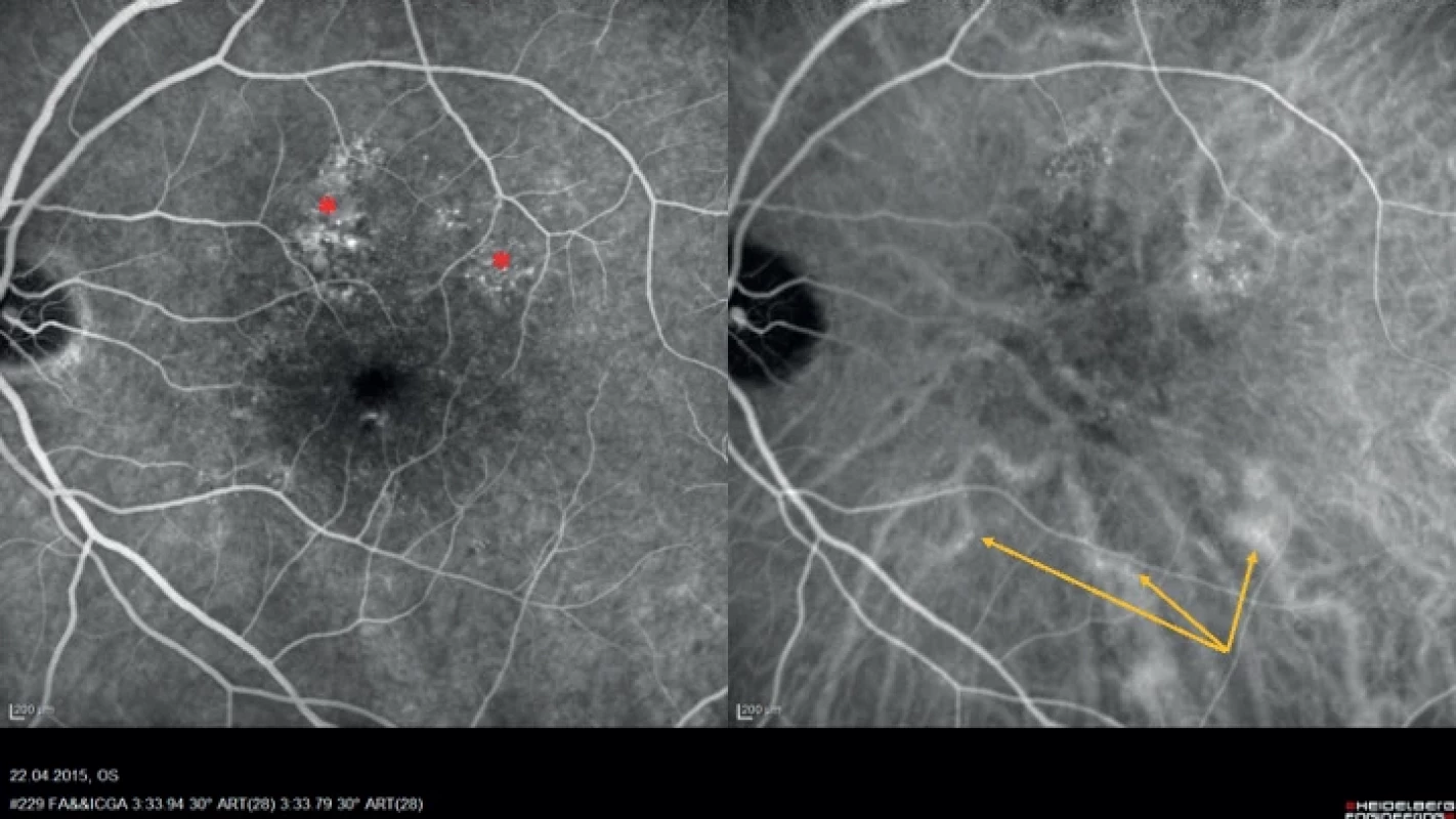 Simultaneous fluorescein and indocyanine green angiographic image in a 58-year-old patient with a multifocal chronic form of central serous chorioretinopathy (Heidelberg Spectralis, Myslík Manethová):