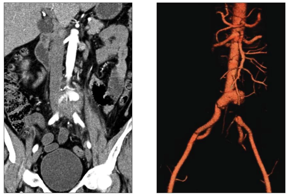 Mykotické aneuryzma bifurkace aorty s přesahem na a. iliaca comm. l. sin. a s jejím tromboembolickým uzávěrem
Fig. 2. Mycotic aneurysm of the aortic bifurcation extending to the left common iliac artery with its thromboembolic occlusion