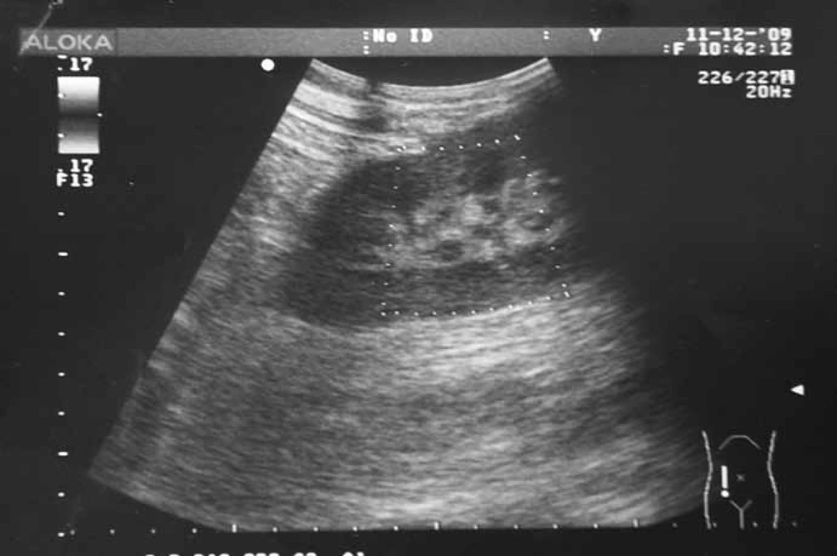 USG nález akútnej trombózy art. renalis transplantovanej obličky (kazuistika – pac., 28 r.; 11 týždňov po transplantácii).