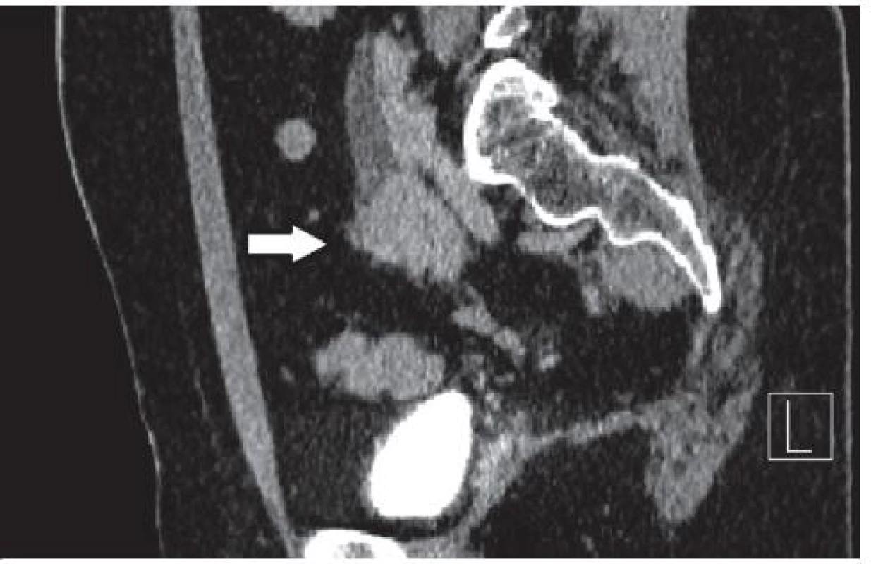 CT po podání kontrastní látky intravenózně – šipka ukazuje na tumor močovodu
Fig. 1. CT after administration of intravenous contrast material – the arrow points to the tumor ureter
