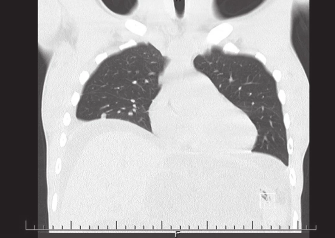 CT hrudníku 23. 5. 2014
Fig. 2: Chest CT scan 23. 5. 2014