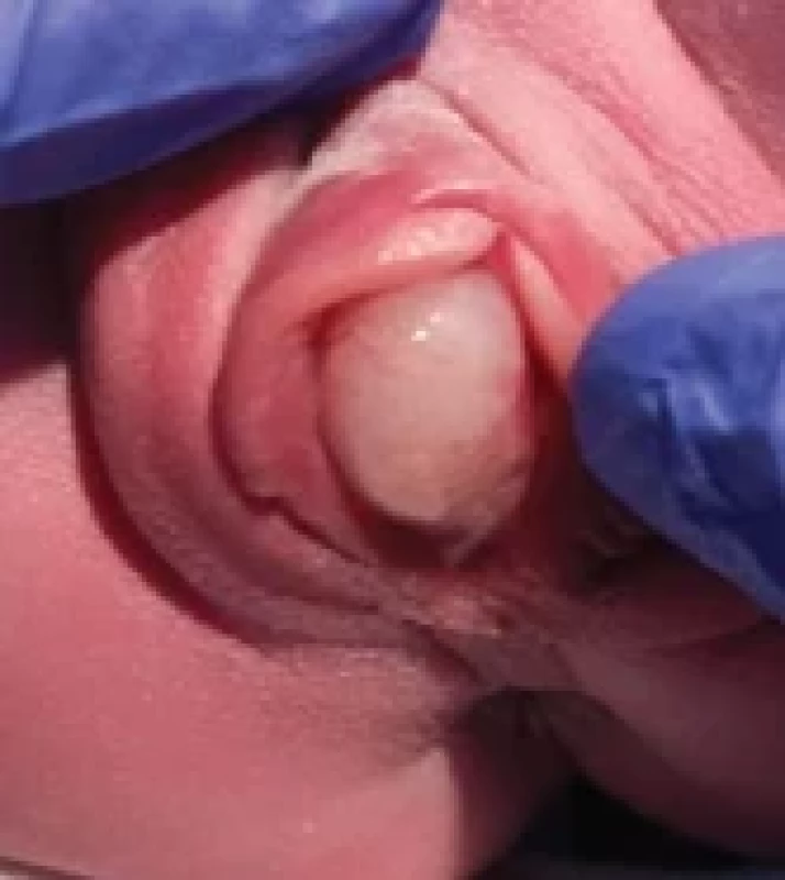 Hymenal cyst in 1-day-old newborn. Obr. 1. Hymenální cysta u 1denního novorozence.