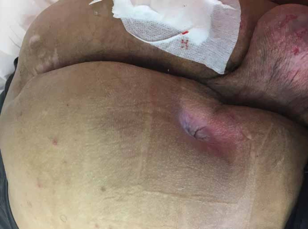Píštěl ischiadického dekubitu vlevo, sakrální dekubitus.
Fig. 4. Fistula of the left ischidaic (sciatic) pressure ulcer, sacral decubitus (pressure ulcer).