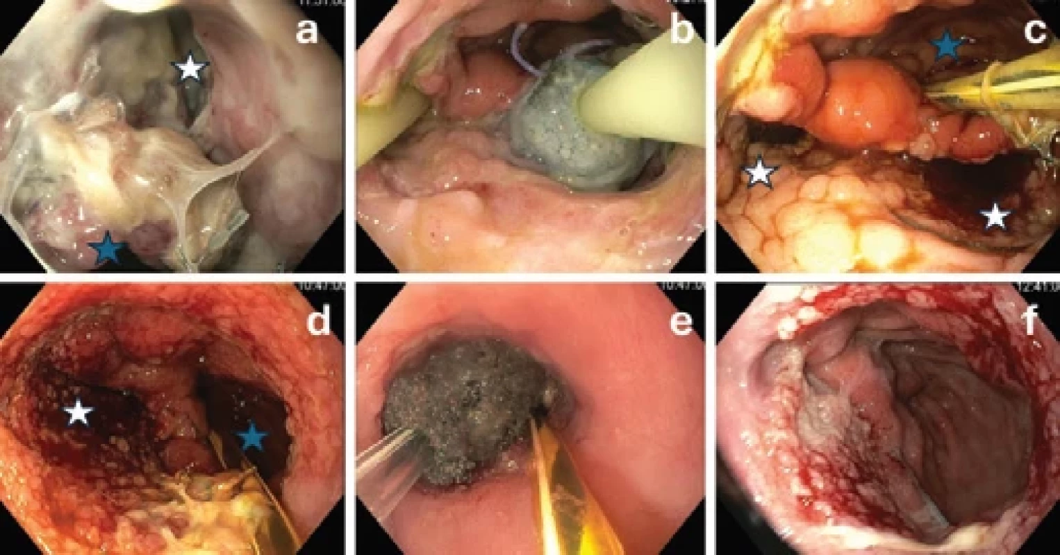 Endoskopická fotodokumentace průběhu léčby anastomotické dehiscence gastroezofageální anastomózy (GEA) pomocí EVT.