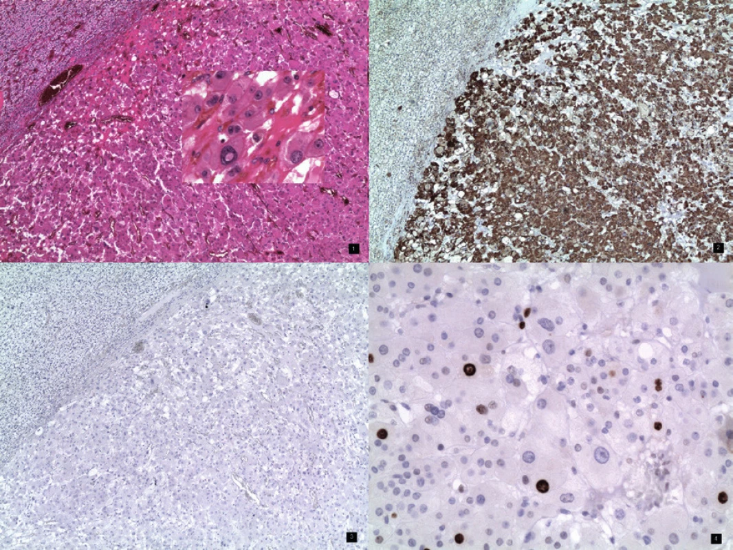1. Onkocytom nadledviny s okrajem tlakově atrofické adrenální kůry. Barvení hematoxylin – eozin, obj. 4×. Vložený obrázek – onkocyty – detail, zvětšení 20×
2. Onkocytom nadledviny se silně pozitivním imunohistochemickým průkazem mitochondrií v cytoplazmě nádorových buněk. Slabě pozitivní je i nenádorová kůta nadledviny, obj. 4×
3. Onkocytom nadledviny s negativním imunohistochemickým průkazem chromograninu – neuroendokrinního markeru. Negativní je rovněž kůra nadledviny, obj. 4×
4. Onkocytom nadledviny – imunohistochemický průkaz proliferační aktivity – Ki-67 (MIB1). Jaderná pozitivita nádorových buněk ložiskově variabilní celkově 7%