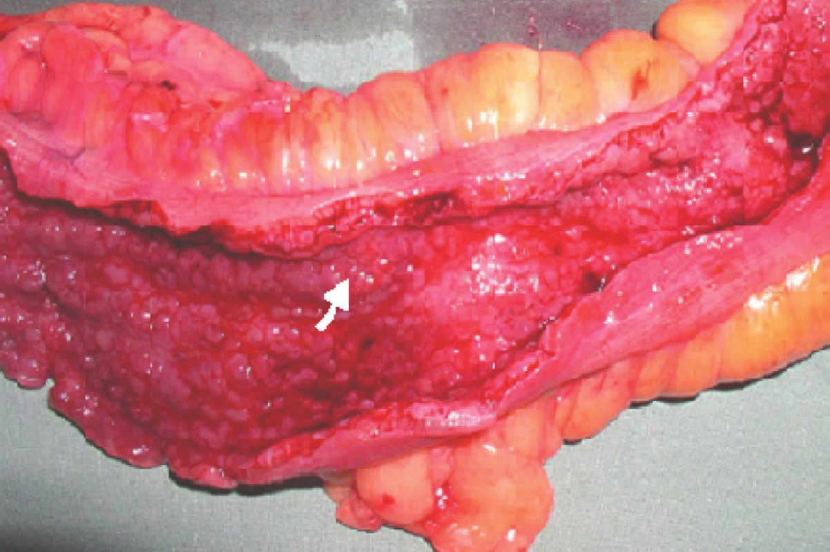 Karcinom sigmoidea v terénu UC – místo označeno šipkou
Fig. 1. Carcinoma of the sigmoid in a patient with ulcerative colitis – the site marked by an arrow