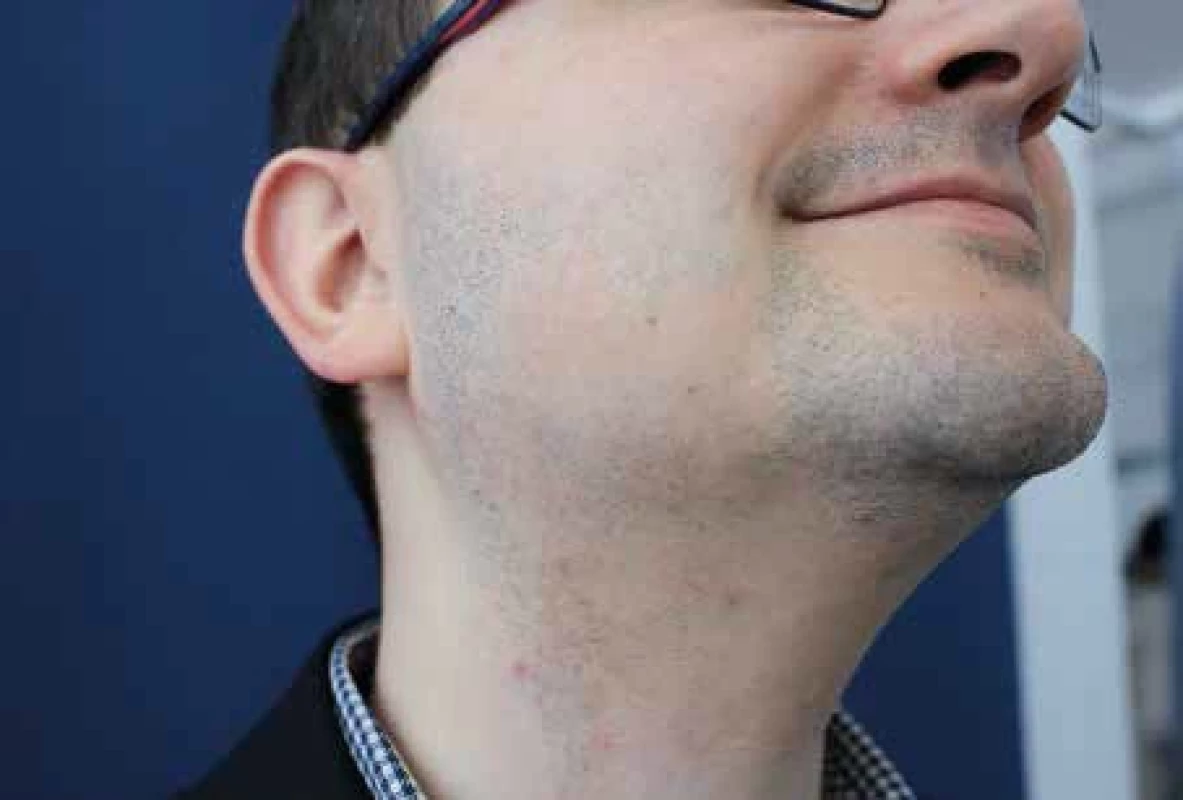Alopecia areata ve vousu. [Foto: Z archivu Dermatovenerologické kliniky 2. LF UK a FNB.]