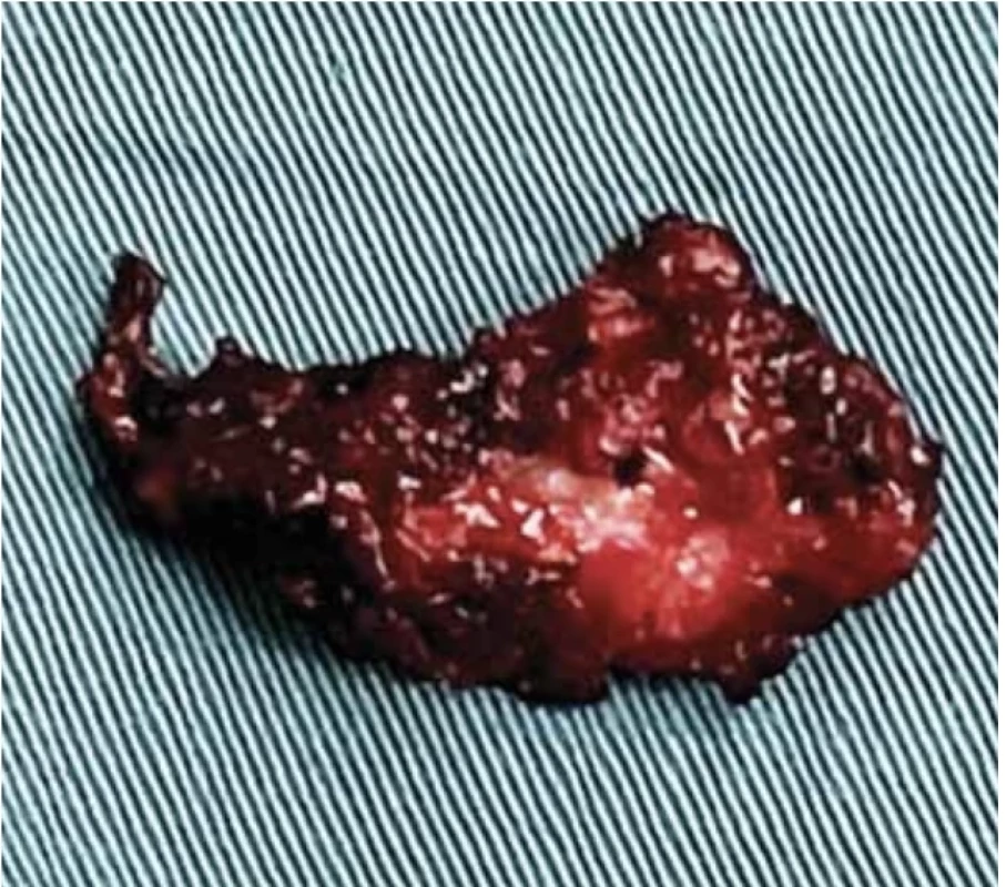 General image of the nodule. // Obecný obraz uzliny.