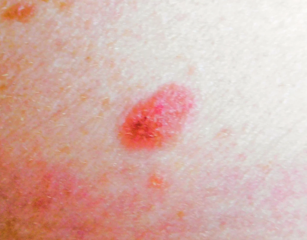 Incipientní, povrchově se šířící melanom <i>in situ</i>