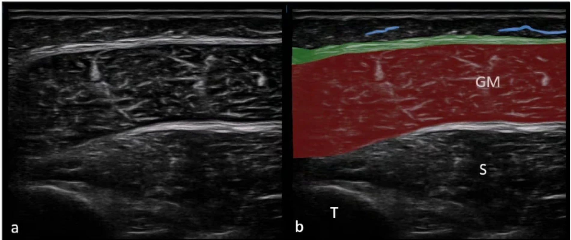  Zobrazení fascia cruris v lokalizaci posterior 1 na nativním sonografickém snímku (a) a na barevně zvýrazněném sonografickém snímku (b). Superficiální fascie je znázorněna modrou linií. Hluboká fascie (zelená linie) přechází přes GM.  Fig. 10. Imaging of the crural fascia in the posterior 1 location in the original ultrasound image (a) and in a color-enhanced ultrasound image (b). The superficial fascia is represented by a blue line. The deep fascia is represented by a green line over the medial belly of the GM.