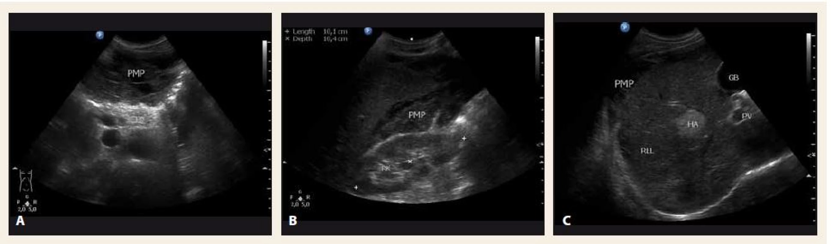 Sonografické vyšetření břicha v době diagnózy – A. příčný řez epigastriem; B. hmoty pseudomyxomu peritonea (PMP) mezi pravou ledvinou (RK) a pravým jaterním lalokem (RLL); C. RLL. 
PB – tělo pankreatu, HA – hemangiom, GB – žlučník
Fig. 2. Abdominal ultrasound at the time of diagnosis – A. transverse section; B. mucinous material of pseudomyxoma peritonei (PMP) between the right kidney (RK) and the right liver lobe (RLL); C. RLL. 
PB – pancreas body, HA – hemangioma, GB – gallbladder
