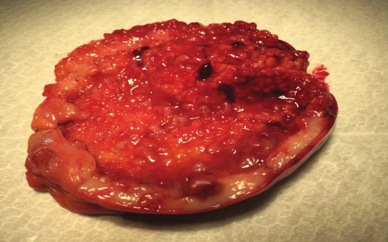 Roztřižený preparát žlučníku
Fig. 5: Cut-open specimen of the gallbladder