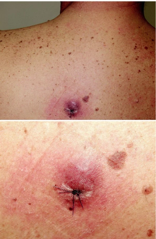 Metastáza karcinomu plic (a – přehled, b – detail).