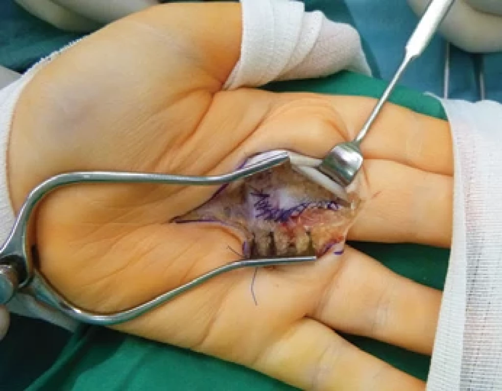 The A1 pulley suture for the replacement of the volar plate, fl exor tendons retracted.